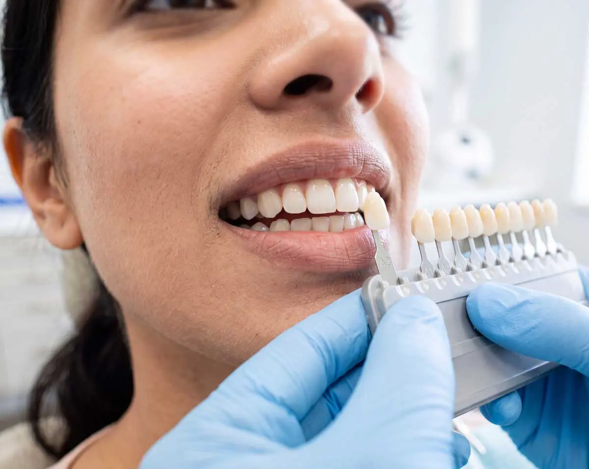 Facetas e lentes de contato dental