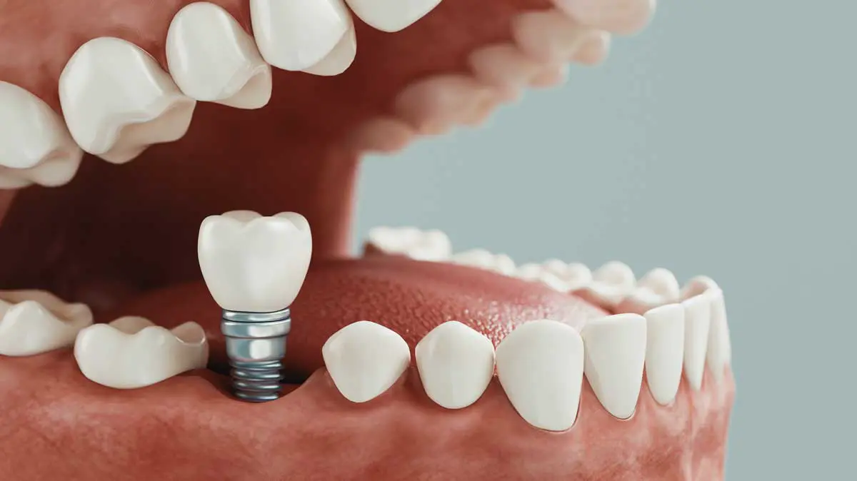 Implante dentário