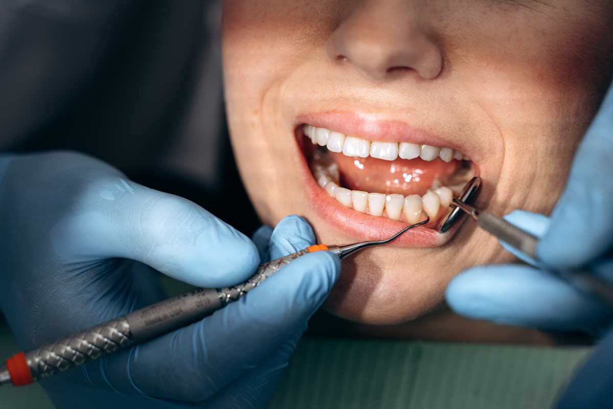 Profilaxia e limpeza dentária